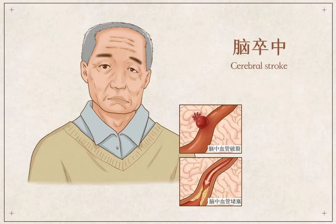 全國高血壓日丨血壓高了，會損傷這幾個器官，如何預(yù)防(圖5)