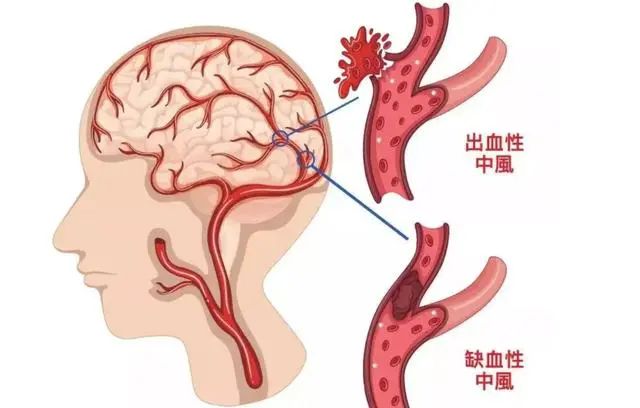 為什么中國腦梗越來越多，美國卻在減少？醫(yī)生：主要原因有這3點(diǎn)(圖1)