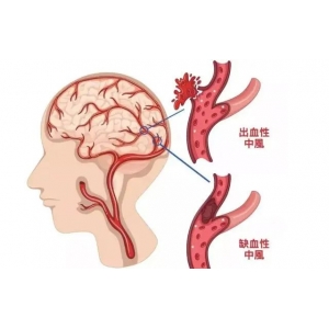 為什么中國腦梗越來越多，美國卻在減少？醫(yī)生：主要原因有這3點(diǎn)